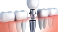 Implantes Dentales