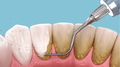 Periodoncia